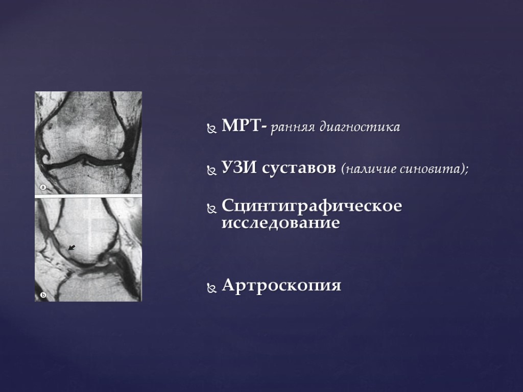 МРТ- ранняя диагностика УЗИ суставов (наличие синовита); Сцинтиграфическое исследование Артроскопия
